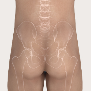 A Mepilex Border Sacrum felhelyezésének 1. lépése